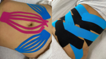 Kinesio-Taping in der Ästhetik